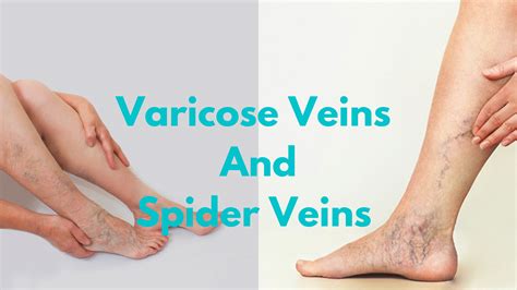 Varicose Veins And Spider Veins Symptoms And Treatment Vloghd