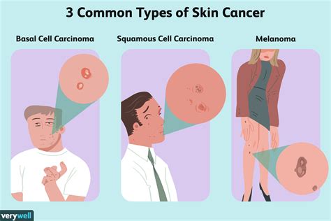 What Is Skin Cancer And What Are Different Types Of S