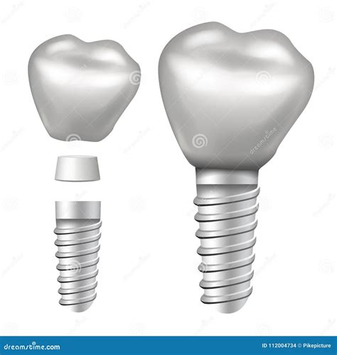 Vector Del Implante Dental Estructura Del Implante Corona Contrafuerte
