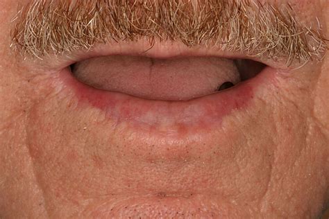 White Oral Lesions Actinic Cheilitis And Leukoplakia Confusions In