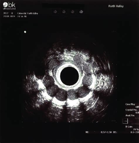 Endoanal Ultrasound Scan Bandk At 6 Weeks Following The Implantation Of Download Scientific