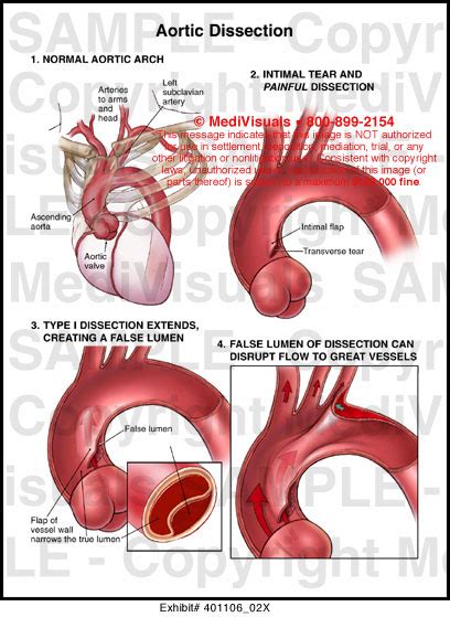 Aortic Dissection Medical Illustration Medivisuals