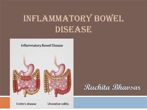Inflammatory Bowel Disease Ppt