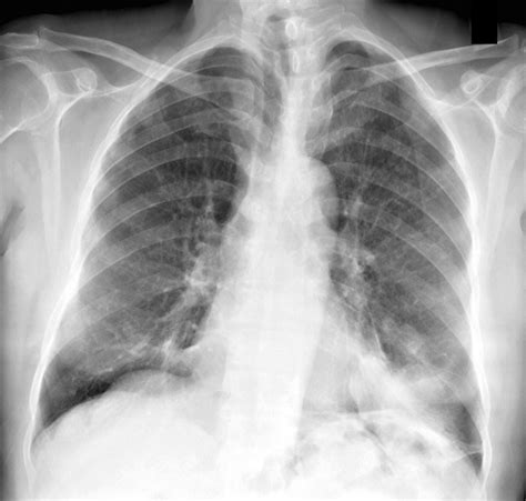 Cryptococcal Pneumonia In An Immunocompetent Patient AJR