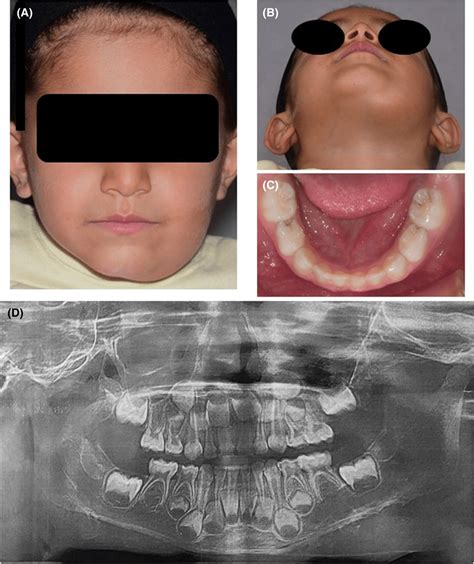 A And B Extra‐oral Views Demonstrating The Swelling In Submandibular