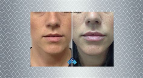 Lip Enhancement Women Lip Fillers And Injections Gold Coast