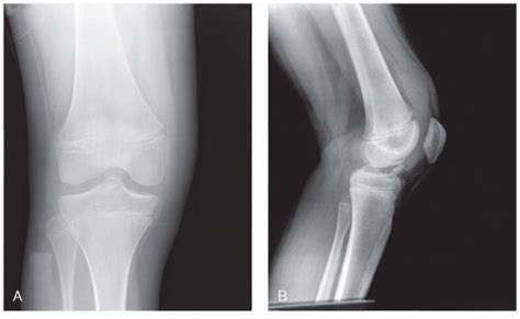Surgical Reduction And Fixation Of Tibial Spine Fractures In Children
