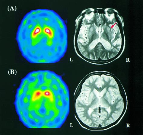 Differential Diagnosis Of Parkinsons Disease And Vascular Parkinsonism