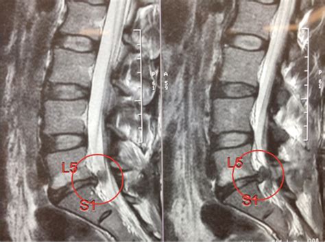Lumbar Spine L5 S1 Related Keywords Suggestions Lumbar Spine L5 S1