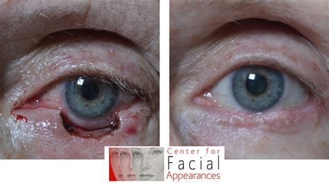 Skin Cancer Eyelid Before After Center For Facial Appearances