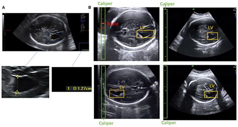 Third Ventricle Fetal Ultrasound