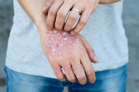 Psoriasis Vs Eczema Whats The Difference Specialists In