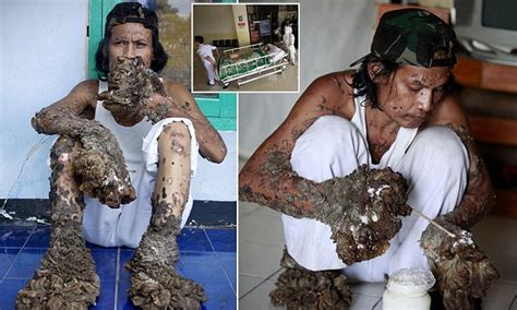 Signs and symptoms the history warts/tumors skin. Indonesian known as 'the tree man' due to disease dies ...