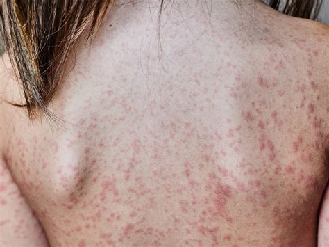 What Is Allergic Reaction Mean