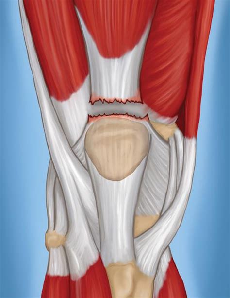 Quadriceps Tendonitis Causes Treatment Knee Pain Expl