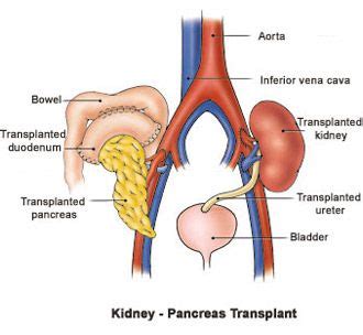 There are seven upper ribs, known as true ribs, which attach to the sternum (breastbone. pancreas kidney transplant | Kidney - Pancreas Transplant ...