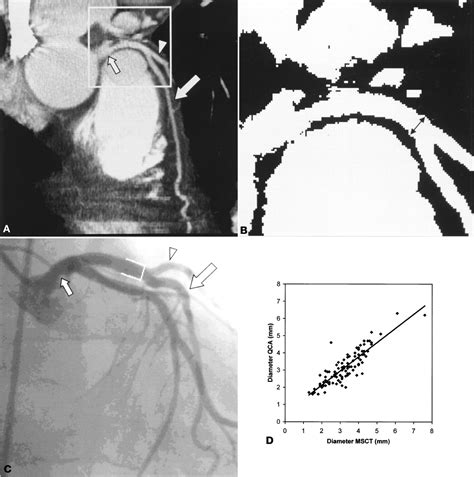 Noninvasive Coronary Angiography By Retrospectively Ecg Gated