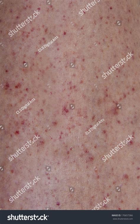 Close Petechiae Skin Rash Stock Photo 170657366 Shutterstock