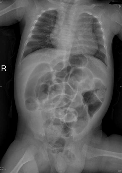 The indirect inguinal hernias occur lateral, or to the outside of those superficial epigastric vessels. Paediatric small bowel obstruction from incarcerated ...