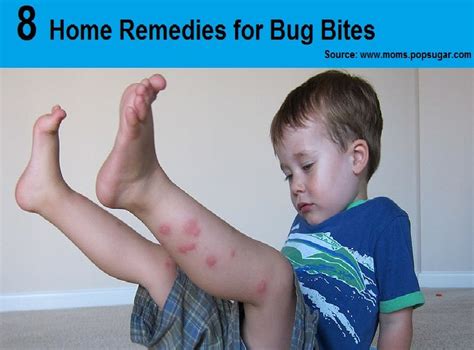 8 Home Remedies For Bug Bites Bug Bites Remedies Home Remedies Remedies