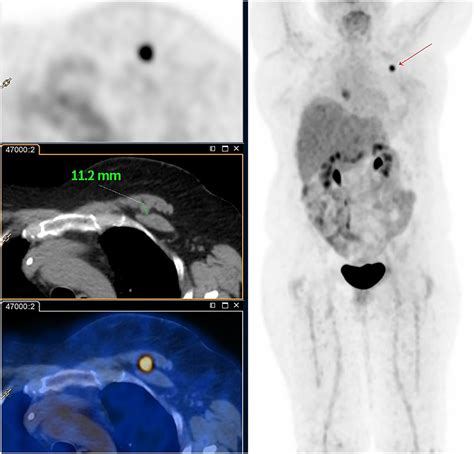 18f Fdg Petct For Staging And Restaging Of Breast Cancer Journal Of