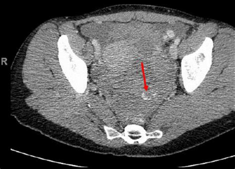 Ct Coronal View Of The Abdomen And Pelvis Showing Extravasation Of