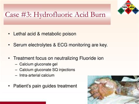Ppt Chemical Burns Powerpoint Presentation Free Download Id590440
