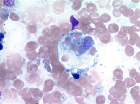 Hemophagocytic Lymphohistiocytosis College Of American Pathologists