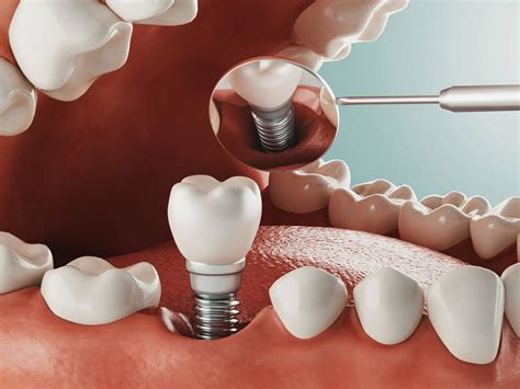 Dental Implants Procedure And Cost Suburban Dental Germantown Md