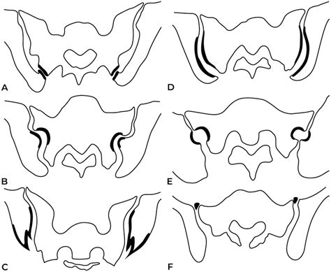 Classification Of Anatomical Variants Of The Sacroiliac Joint By My Xxx Hot Girl