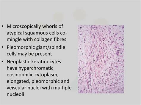 Ppt Squamous Cell Carcinoma Powerpoint Presentation Free Download