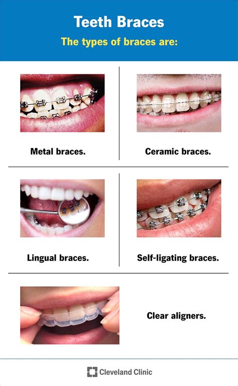 How Braces Work Different Types Of Orthodontics Vondran Orthodontics