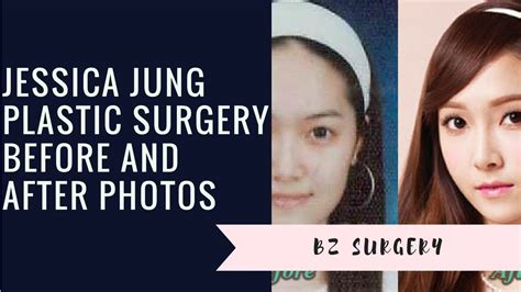 Jessica Jung Plastic Surgery Before And After Photos Youtube