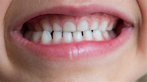 It happens when bacteria in your mouth make acids that attack the enamel. Torbay has the highest number of kids with tooth decay ...