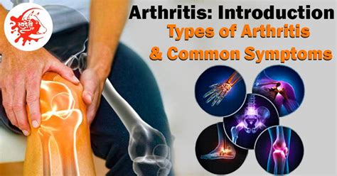 Arthritis Introduction Types Of Arthritis And Common Symptoms