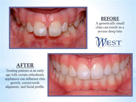A missing tooth can create problems with the alignment of your jaw and for the rest of your teeth as they gradually move to fill in the blank space. A case that Dr. West completed. #braces #orthodontist #straightteeth #teeth #before #after www ...