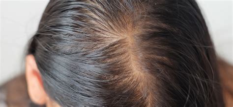 Female Pattern Baldness Causes Treatments