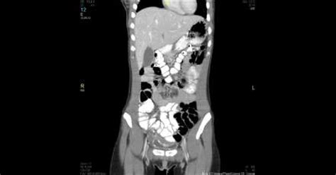 Ct Scan Showing Perforated Appendix With Extraluminal Contrast In The