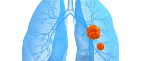 Some common symptoms of lung cancer include, according to lungcancer.com More Than a Cough: Lung Cancer Symptoms | UPMC