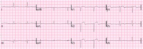 Dr Smiths Ecg Blog Patient Presentation Is Important And So Is R