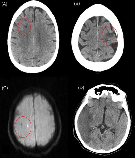 Neuroimaging Patterns Of Stroke After Acute Type A Aortic Dissection