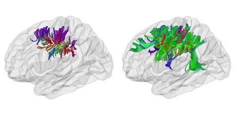 Tightly Folded Autism Brain Tied To Dense Neural Connections Spectrum