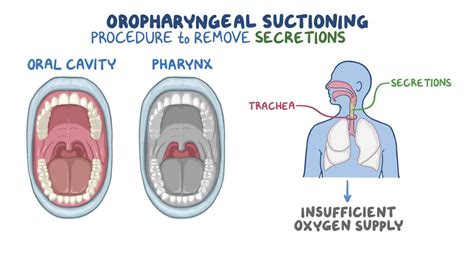 Respiratory Oropharyngeal Suctioning For Nursing Assistant Training
