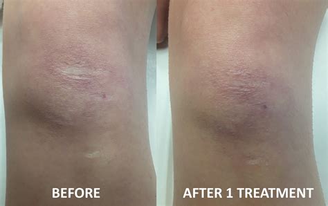Scar Before And After Treatment Revive Laser And Skin Clinic
