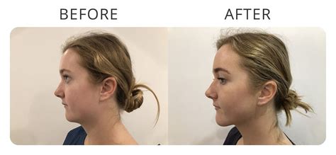 Double Chin Removal And Neck Liposuction In Sydney My Cosmetic Clinic