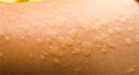 Allergy Rashes In Children