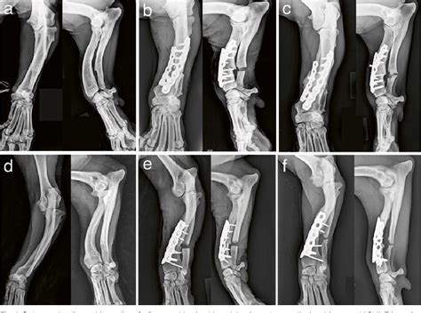 Figure 1 From Three Dimensional Computer Assisted Corrective Osteotomy