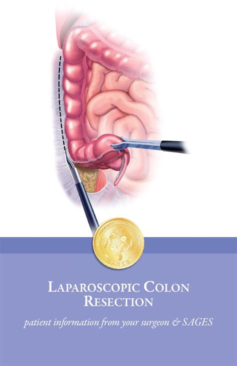 Laparoscopic Colon Resection Patient Information From SAGES