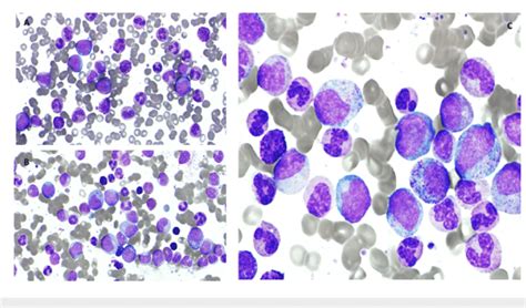 A Peripheral Blood Smear B And C Bone Marrow Aspirate Smear A