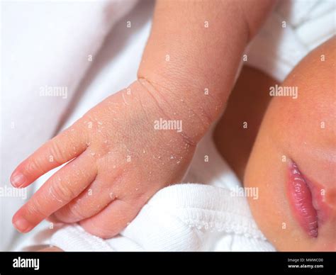 Foot Skin Peeling High Resolution Stock Photography And Images Alamy